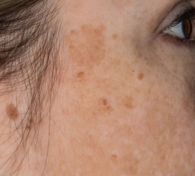 Picture of skin unevenness and hyperpigmentation