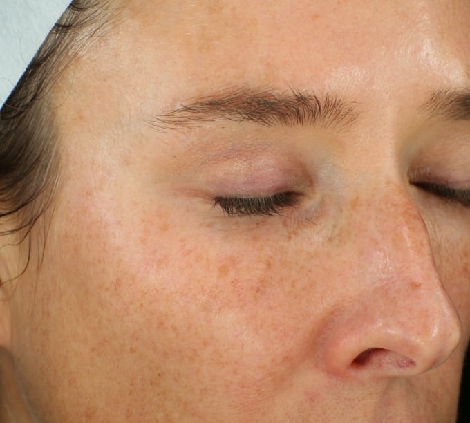 Picture of woman with pigmentation spots and skin dullness
