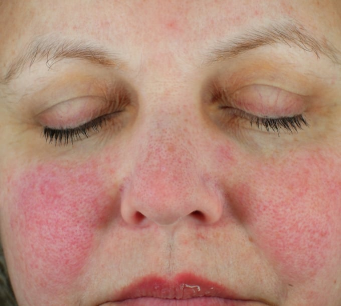 Picture of woman with skin redness and irritation