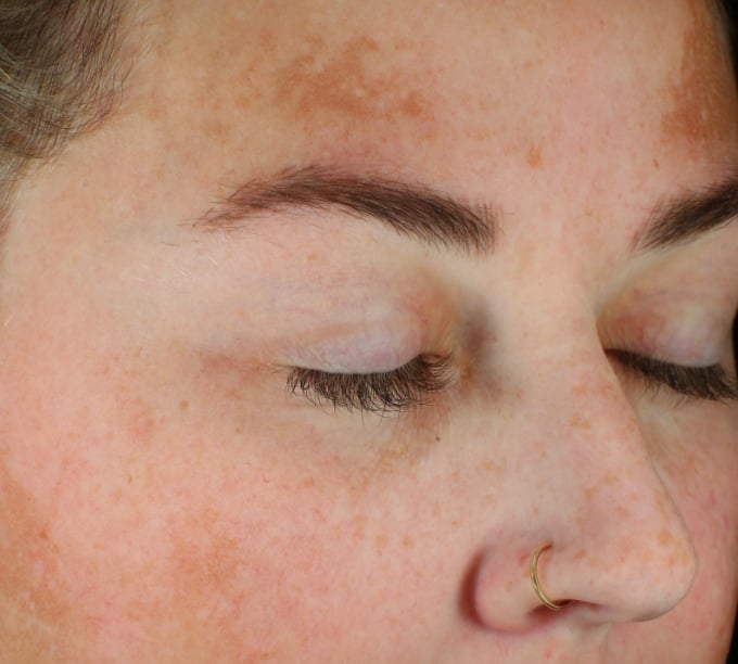 hyperpigmentation like age spots or sun damage example