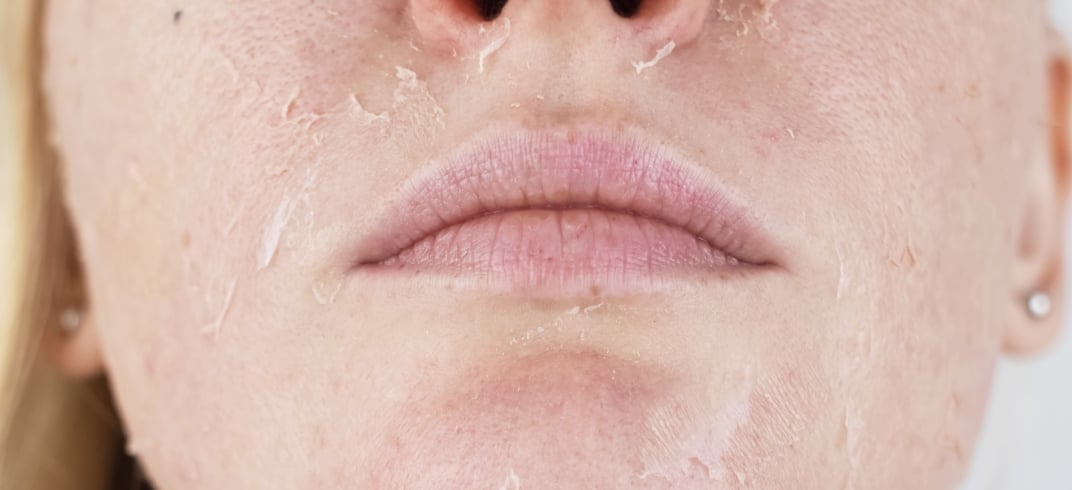skin renewal and facial peel